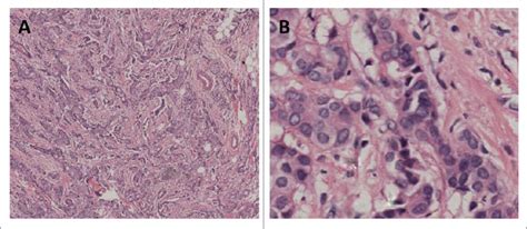 Histology of the resected mastectomy specimen ( H & E, original ...