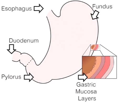 Curling's Ulcer - Nursing Review (Video)