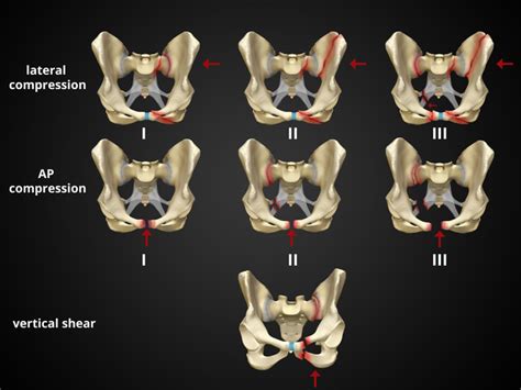 Pelvic fracture diagrams | Radiology Case | Radiopaedia.org