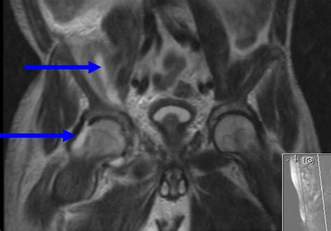 A case report of a septic hip secondary to a psoas abscess | Journal of ...