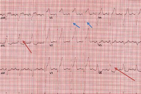 Left Bundle Branch Block Ecg