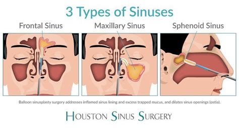 Houston Balloon Sinuplasty Surgery - Houston, TX: Houston Sinus Surgery