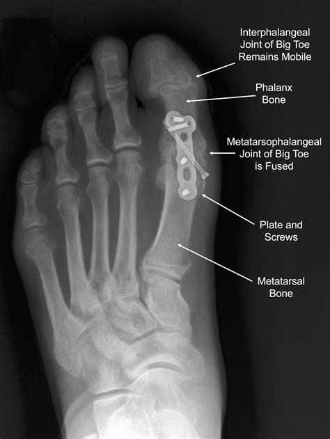 Big Toe Arthritis — Daniel Bohl, MD | Midwest Orthopaedics at RUSH