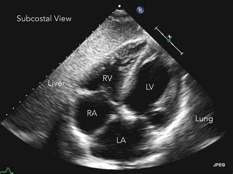 Subxiphoid Ultrasound