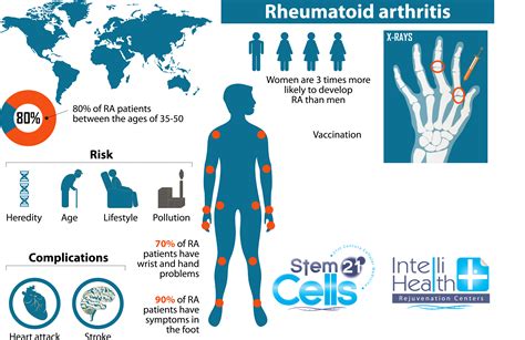 sc21 arthritis RA | Adult Stem Cell Therapy Abroad, Stem Cell Clinic in ...