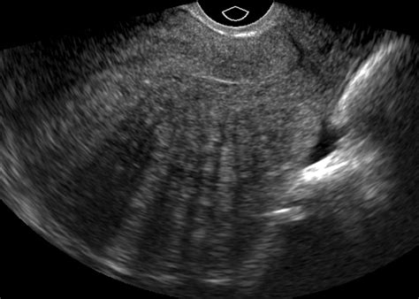 Adenomyosis: A Sonographic Diagnosis | RadioGraphics