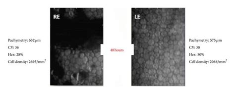 Specular microscopy of the RE shows polymegathism and pleomorphism; CV ...