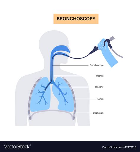 Bronchoscopy procedure concept Royalty Free Vector Image