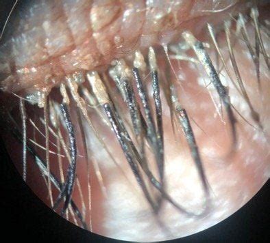 Eyelash Mites: Identifying Symptoms, Getting Rid of Them