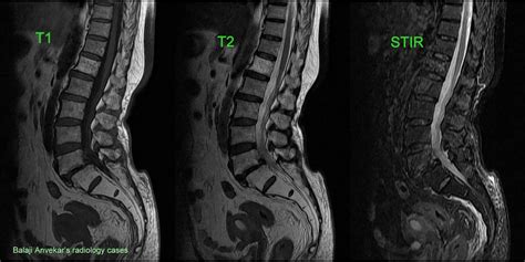 VERTEBRAL BODY HEMANGIOMA MRI RADIOLOGY - Wroc?awski Informator ...