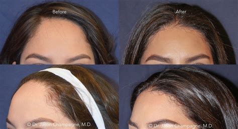 Dr-Jason-Champagne-Hairline-Lowering-Before-and-After | Forehead ...