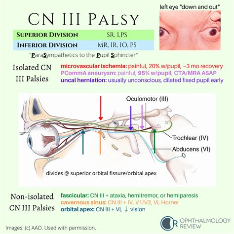 Localization of Third Nerve (CN3) Palsies — Ophthalmology Review