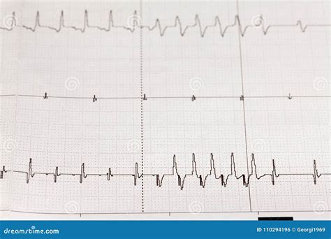 Electrocardiograma ECG/ECG Con Arritmia Cardiaca Foto de archivo ...