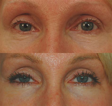 Laser Resurfacing for the Eyes