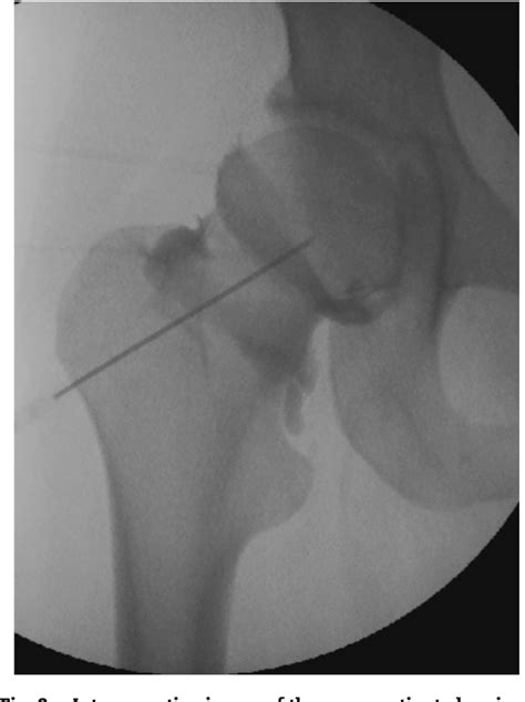 Figure 2 from Efficacy of using an air arthrogram for EUA and injection ...