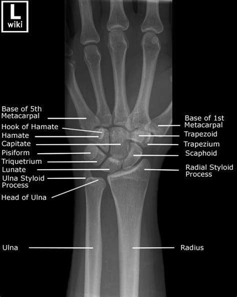 Wrist Radiographic Anatomy - wikiRadiography | Radiology student ...