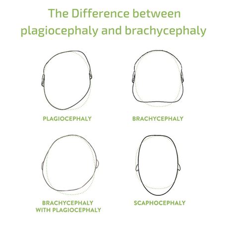 Curious about the difference between plagiocephaly and brachycephaly ...