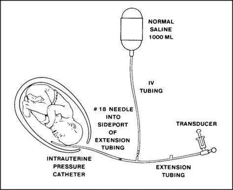 Using Amnioinfusion for the Relief of Repetitive Variable Decelerations ...