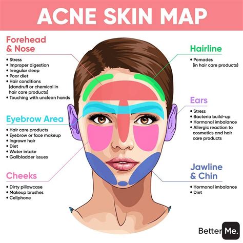 Proskin Aesthetics on Instagram: "THIS IS WHAT ACNE SAYS ABOUT YOUR ...