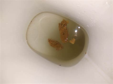 Great Brown Mucus In Stool Check it out now | stoolz