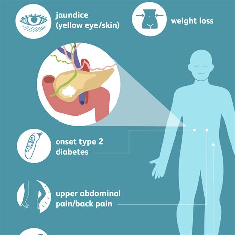 Pancreatic Cancer: Signs, Symptoms, and Complications