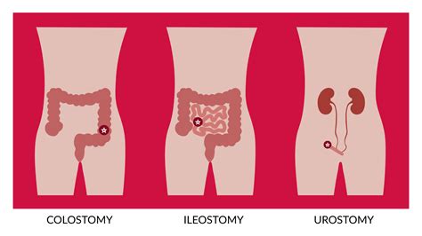 Colostomy vs. Ileostomy vs. Urostomy - Trio Healthcare