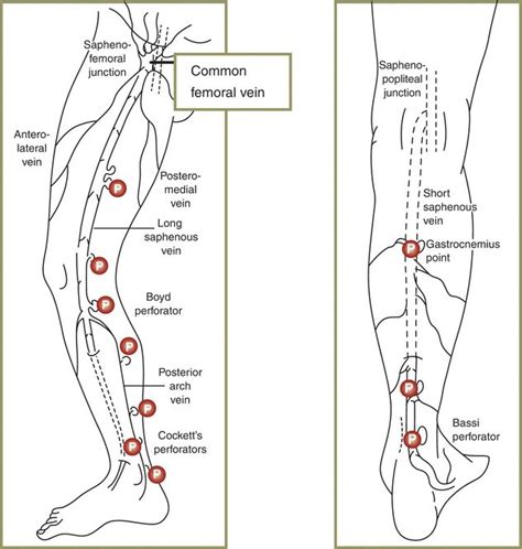 Incompetent Venous Perforators | Thoracic Key