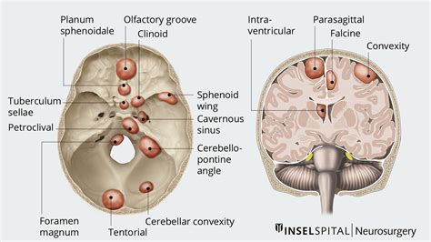 Meningeoma | Neurosurgery Inselspital Bern