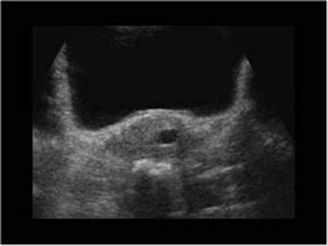 Gynaecology | 3.1 Uterus : Case 3.1.2 Miscellaneous benign uterine and ...