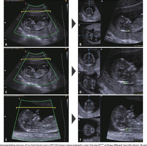 Figure 1 from Image Settings Affecting Nuchal Translucency Measurement ...