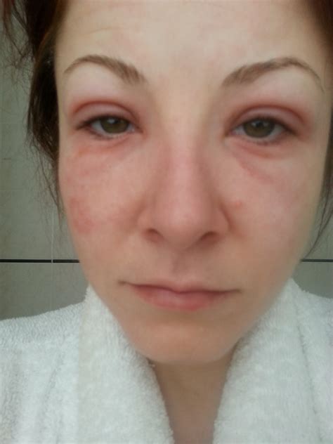 The fear of the swollen face. An allergic reaction to what? - Whoopee ...