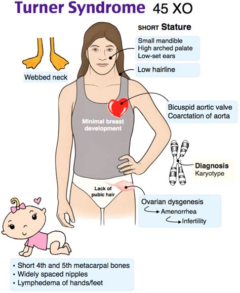 TURNER SYNDROME