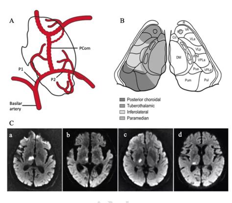 Schematic of the arterial supply of the thalamus and four... | Download ...