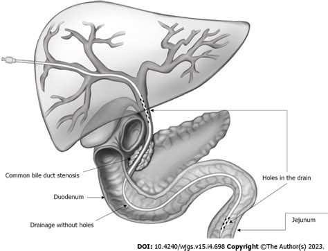 Layout of external-internal biliary-jejunal drainage placement ...