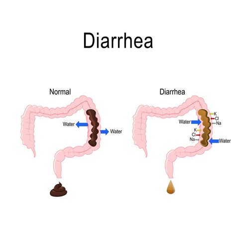 Diarrhea