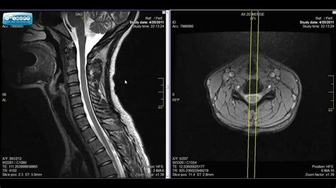 Normal Cervical Spine MRI Explained | Dr. Jeffrey P.Johnson | HD - YouTube