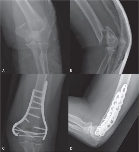 Distal Humerus Fractures | Musculoskeletal Key