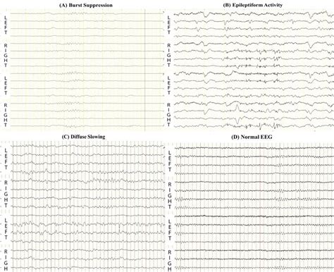 Normal Versus Abnormal Eeg