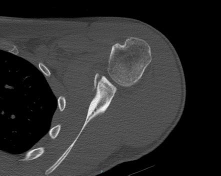 Bankart Lesion Mri