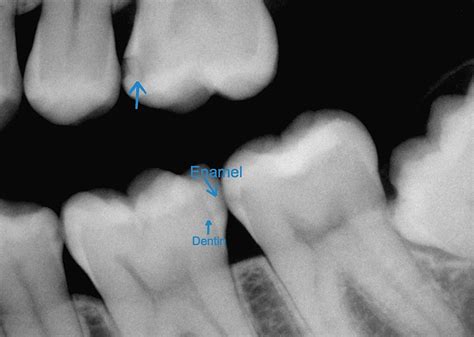 Why Do I Need X-rays? | DeForest Dental