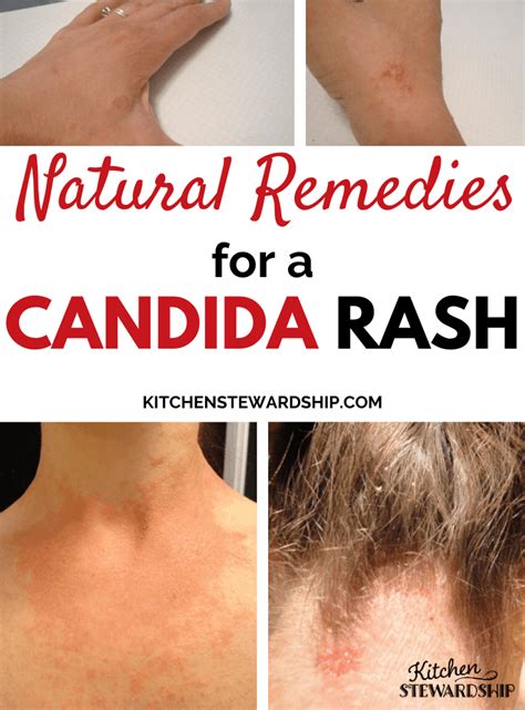 Candida Rash On Neck