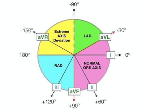 Cardiac Axis Deviation: ECG Interpretation - Nurse Your Own Way