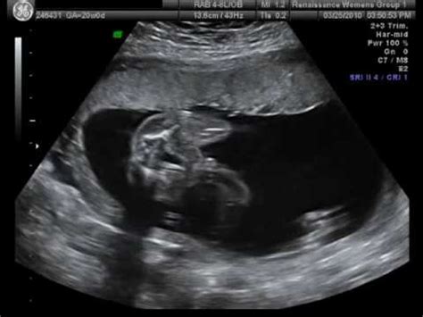 Baby Ultrasound: Baby Ultrasound Photos