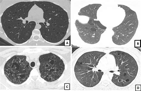 Pulmonary Insights | Diffuse Cystic Lung Diseases: Definitive Diagnosis ...