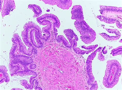 Villous Adenoma Histology