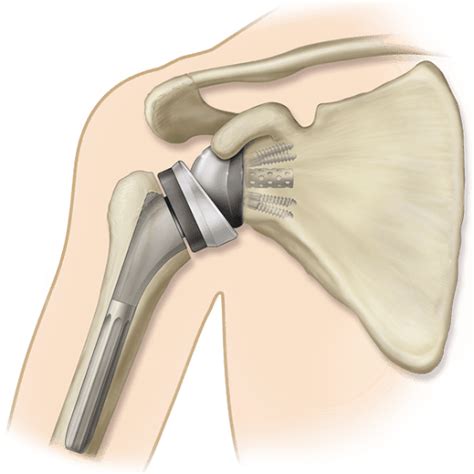 Shoulder Replacement - Melbourne