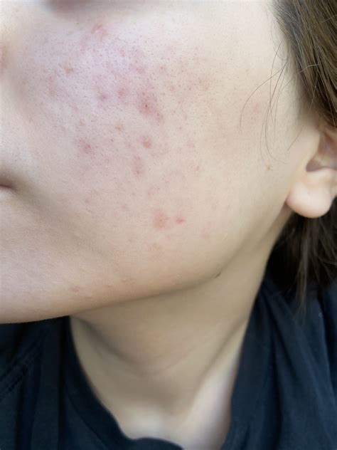 Do you think this is hyperpigmentation? - Hyperpigmentation - red/dark ...