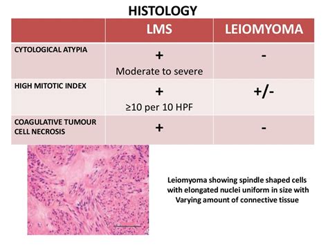 UTERINE LEIOMYOSARCOMA