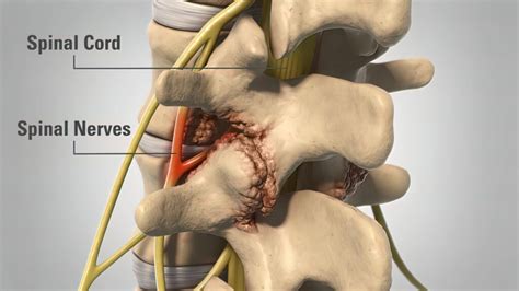 Lumbar Laminectomy Surgery: Procedure, Risks, Recovery