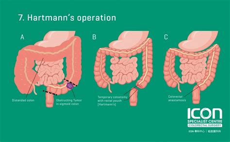 Colorectal resection (colectomy) — Icon Specialist Centre